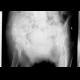 Duverney fracture, fracture of iliac wing: X-ray - Plain radiograph